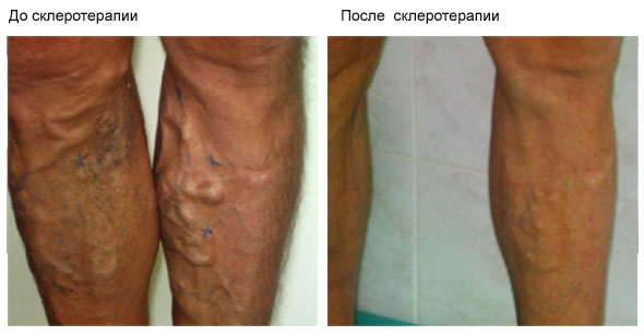 До и после склеротеропии