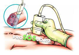 ультразвуковое исследование полового члена