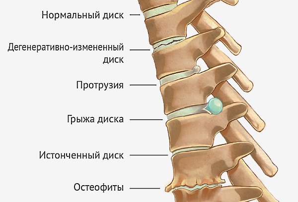 Различные дегенеративные изменения и искривления позвоночника вызывают боли в спине