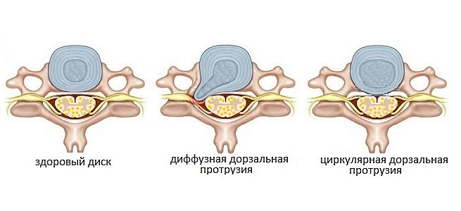 Дорзальная протрузия может быть диффузной и циркулярной