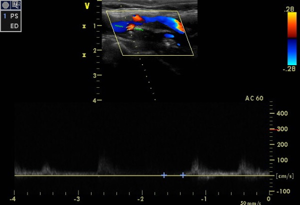 Дуплексное сканирование дает возможность исследовать более глубокие сосуды