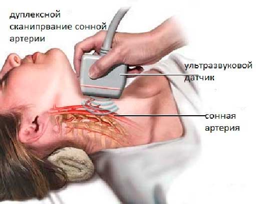 дуплексное сканирование артерий