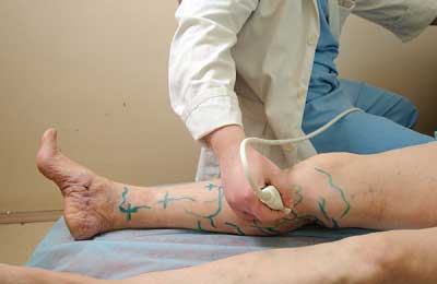 дуплексное сканирование ног