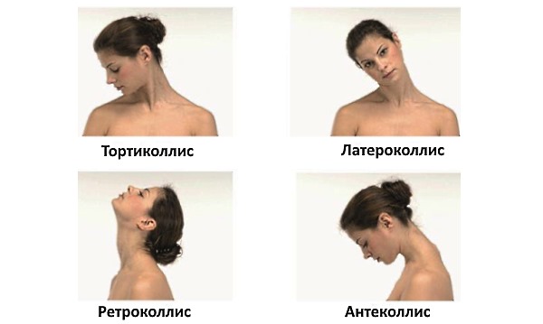 Виды спастической кривошеи относительно положения головы