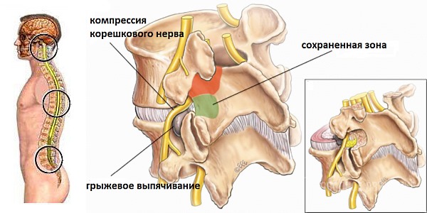 Грыжа позвоночника может размещаться в шейном, грудном или в поясничном отделе