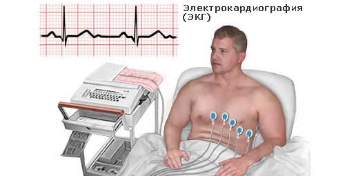 ЭКГ