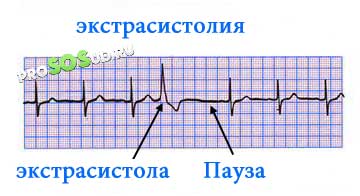 экстрасистолия