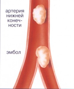 закупорка артерии нижней конечности