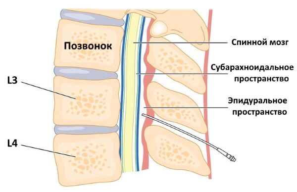 Остеомиелит может привести к абсцессу эпидурального пространства