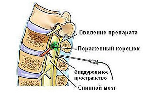 При сильных болях возможно использование обезболивающей блокады
