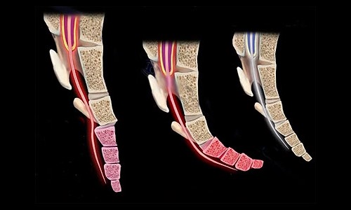 Ниже представлены основные симптомы перелома копчика