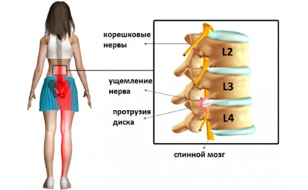 Протрузия может возникать в разных частях позвоночника и характеризуется выпячиванием диска до 3 мм