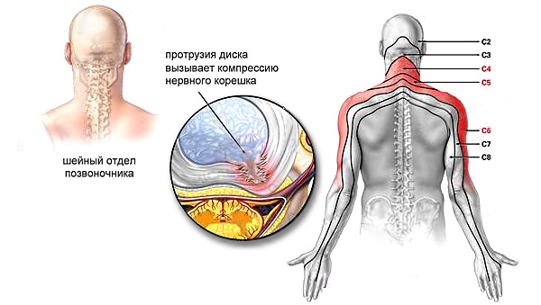 Радикулопатия в шейном отделе возникает при компрессии нервного корешка