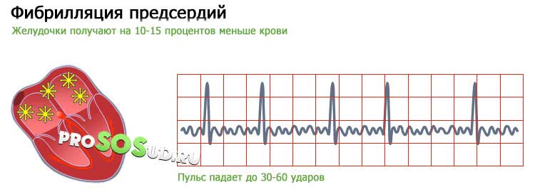 фибрилляцию предсердий