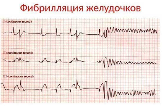 фибрилляция желудочков