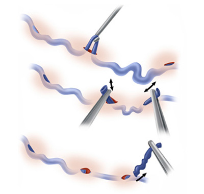 флебэктомия