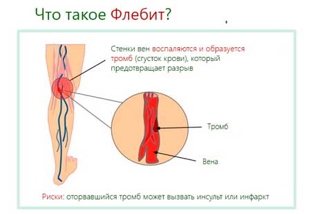 флебит