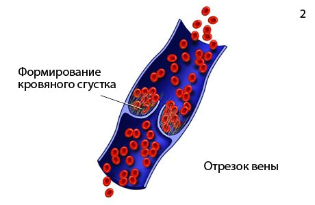 флеботромбоз вены