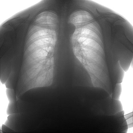 флюорограмма