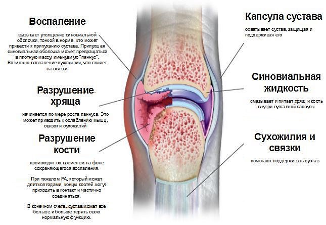 Лефлуномид применяют для лечения ревматоидного артрита