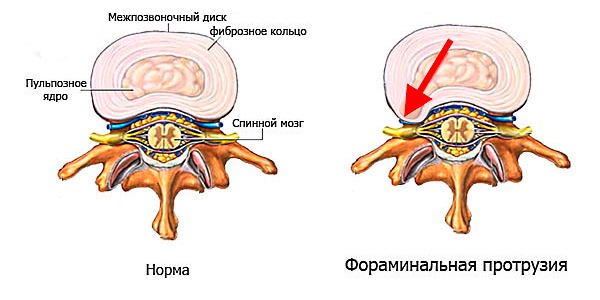Фораминальная грыжа характеризуется выпячиванием диска в направлении нервных корешков