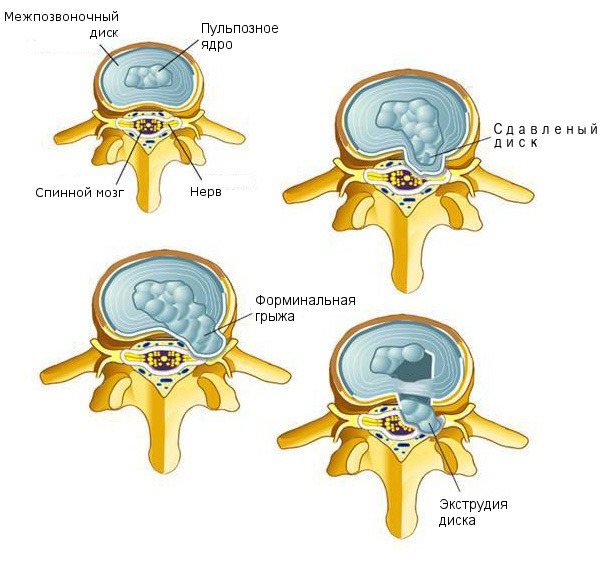 Затягивать с лечением фораминальной грыжи не стоит, так как она достаточно быстро прогрессирует
