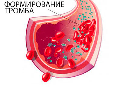 формирование тромба