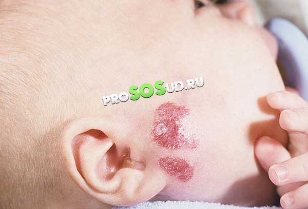 гемангиома на лице ребёнка
