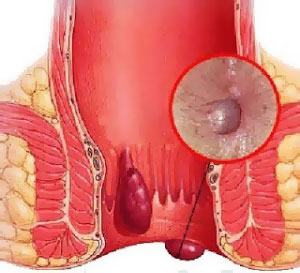 геморроидальный узел