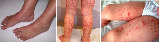 Геморрагическая сыпь у детей