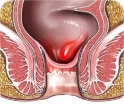 Геморрой в разрезе