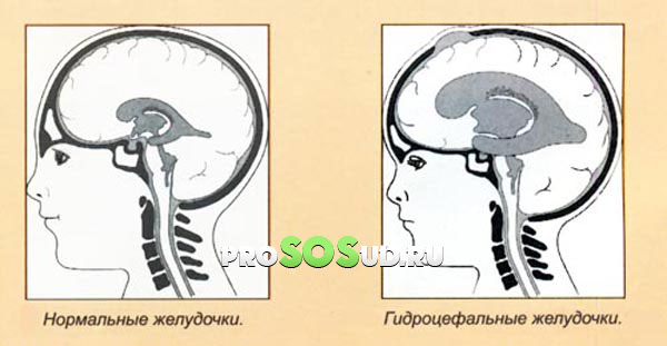 Гидроцефальные желудочки