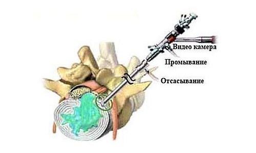 При гидропластике производится частичное удаление пульпозного ядра