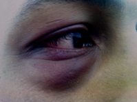 гематома на глазу