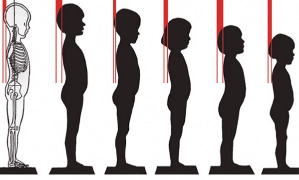 Обратите внимание на причины искривления спины у детей