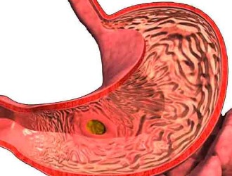Не назначают Кетанов при язве и кровотечениях в желудке