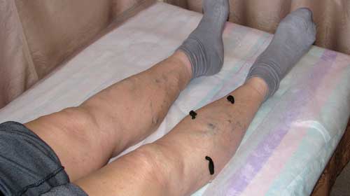 гирудотерапия