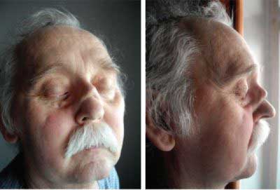 гранулематоз у мужчины