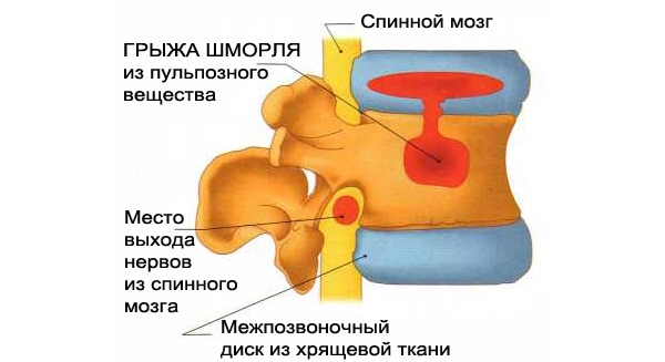 При грыже Шморля межпозвоночный диск вдавливается в тело позвонка