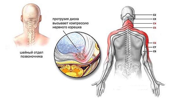 Обратите внимание на локализацию боли при шейной грыже