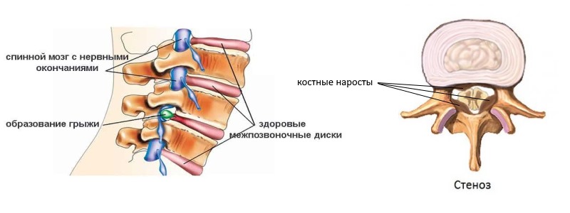 Ортопедический корсет для шеи обязательно применяется в терапии грыжи позвоночника, стеноза и остеохондроза