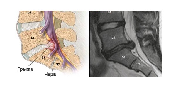 Одной из самых частых причин болей в пояснице является межпозвоночная грыжа
