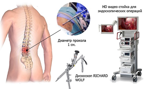 Хирургическое лечение применяют при запущенных стадиях остеохондроза и грыже позвоночника