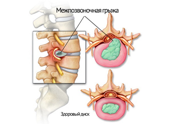Поясничный отдел позвоночника самый уязвимый, поэтому чаще всего страдает от разрыва фиброзного кольца