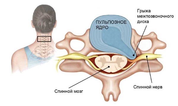 При грыже диска происходит разрыв фиброзного кольца и его выпячивания