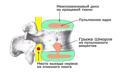 Грыжа Шморля менее опасна, чем межпозвоночная грыжа