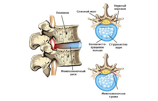 Опоясывающая боль в пояснице часто возникает при остеохондрозе и его осложнениях