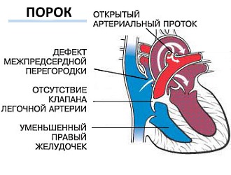 Нельзя принимать таблетки Метиндол Ретард при атрезии легочной артерии