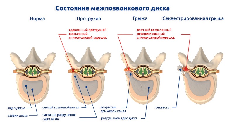 Острый хондроз позвоночника может привести к разрушению межпозвонкового диска и образованию грыжи
