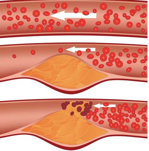 бляшка внутри сосуда